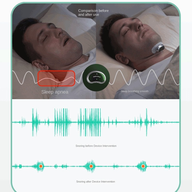 AI-Assisted Anti Snoring Device